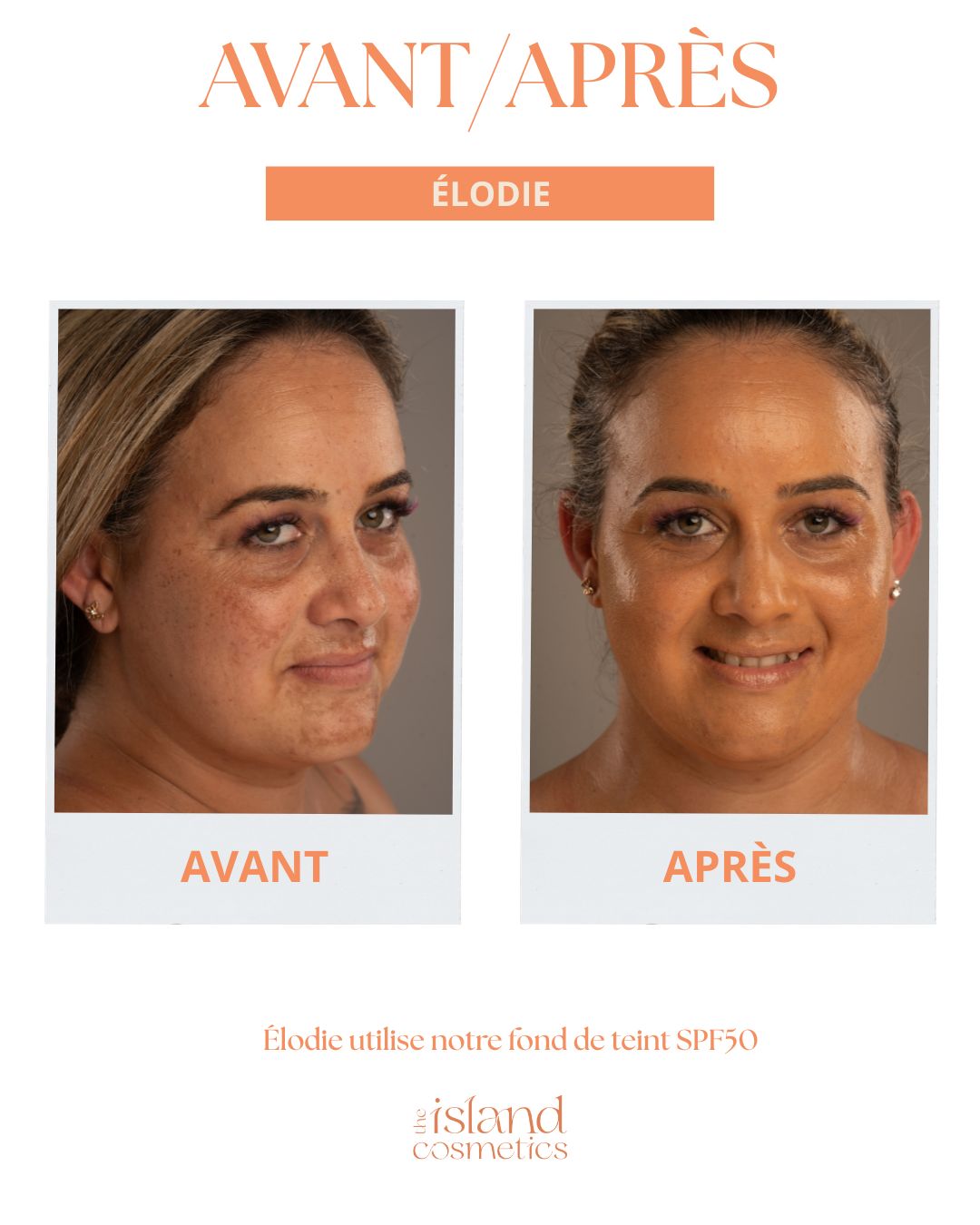 Tâches pigmentaires : pourquoi le soleil marque votre peau (et comment l'en empêcher)