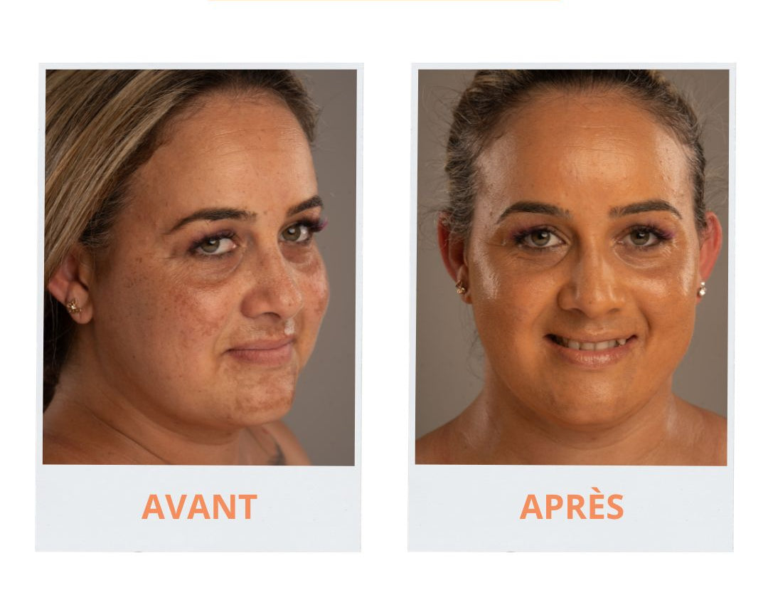 Tâches pigmentaires : pourquoi le soleil marque votre peau (et comment l'en empêcher)